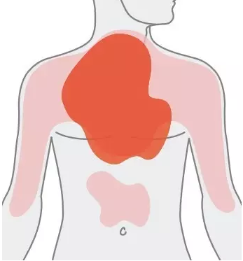 Rys. Lokalizacja bólu wieńcowego. Źródło: Medycyna Praktyczna